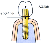 インプラント