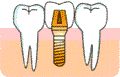 人工の歯の取り付け