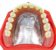 金属床義歯（入れ歯）